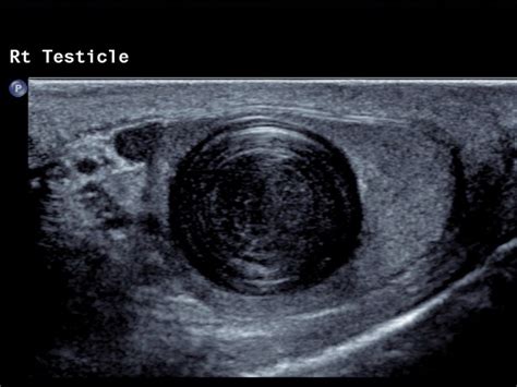 Testicular Pathology Ultrasound