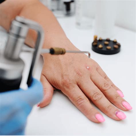 Cryotherapy For Wart Removal Pedcare