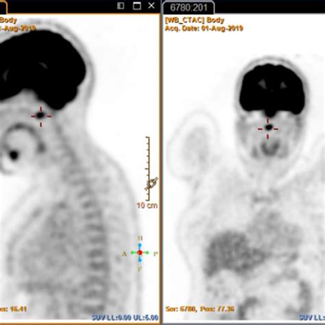 Case Pet Scan Moderate To Intense Fdg Uptake In The Upper Cervical