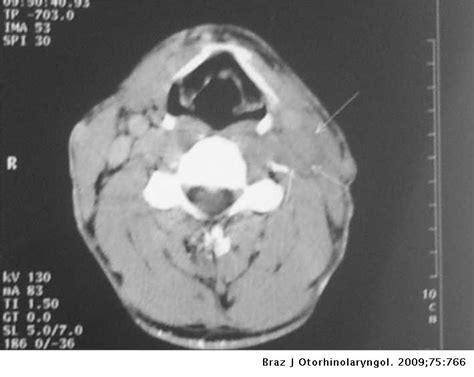 Ct Scan Showed Swollen Lymph Nodes In Neck Ct Scan Machine