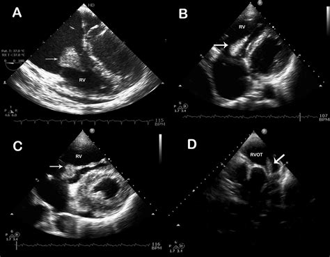 Large Mural Vegetation From Right Ventricle Accompanying Tricuspid