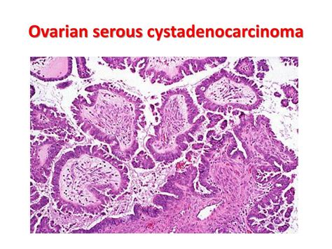 Ppt Ovarian Tumors Powerpoint Presentation Free Download Id2176465