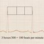 What Is Ecg Heart Rate