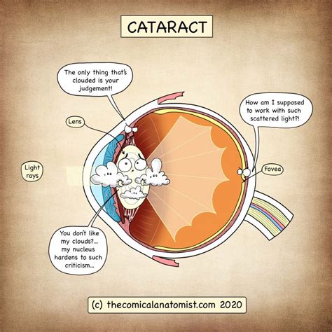 Cataract The Comical Anatomist
