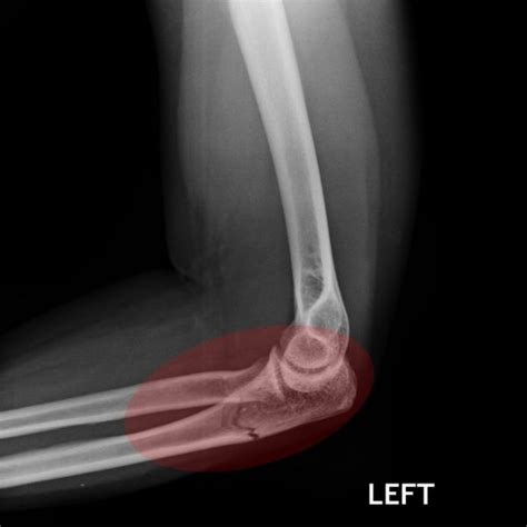Fracture Of The Elbow Area Elbow Specialist South Windsor Rocky