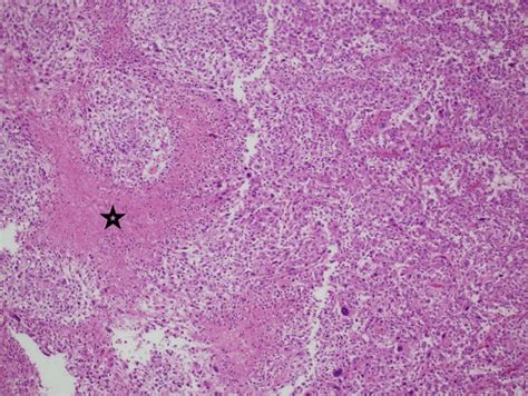 Infantile Atypical Subependymal Giant Cell Astrocytoma Neurosciences