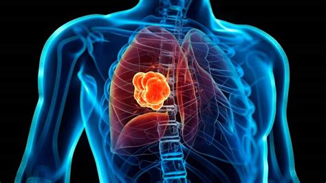 El cáncer de pulmón es la primera causa de muerte por cáncer a nivel