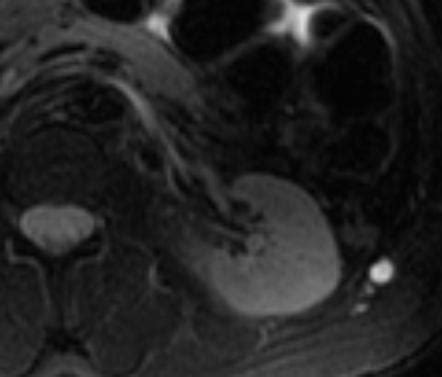 Aneurysmal Bone Cyst Radiology Reference Article Radiopaedia Org