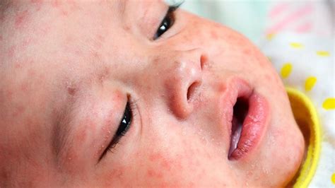 Measles Outbreak Across Europe Bbc News