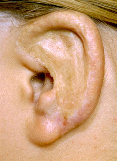 Cosmetic Ear Surgery Top Otoplasty Surgeon Dr Barry Eppley