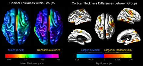 Increased Cortical Thickness In Male To Female Transsexualism