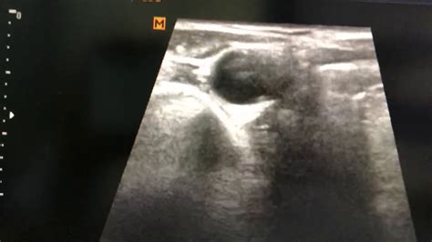 Submandibular Gland Sialolithiasis Ultrasound Youtube