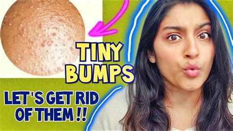 Remove Tiny Bumps On Face Forehead Body Fungal Acne Guide Youtube