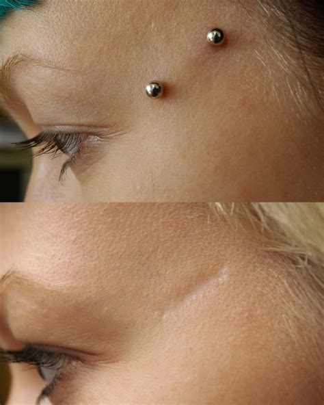 Dermal Piercing—pictures Care Procedure Types Scars Removal
