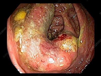 The main disadvantages are the test can miss small polyps, and if your doctor does find some, you'll still need a real colonoscopy. Colon cancer, endoscope view - Stock Image - C033/9743 ...
