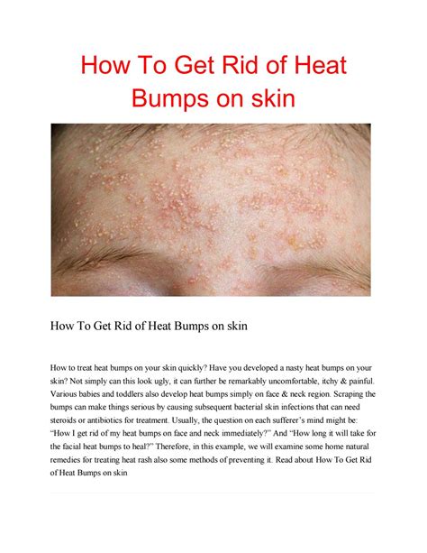 How To Get Rid Of Heat Bumps On Skin By Ankithaanu Issuu