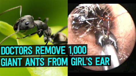 doctors remove 1 000 mysterious giant ants from girl s ear youtube