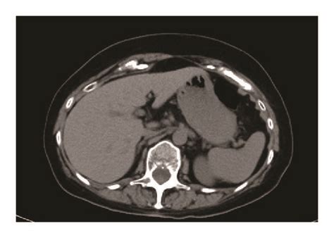 Abdomen Ct Showing Adrenal Glands Normalized In Volume 6 Months Later