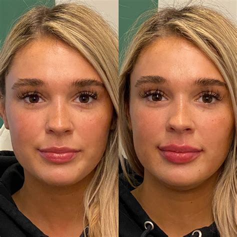 Botox Injections In Lips Before And After