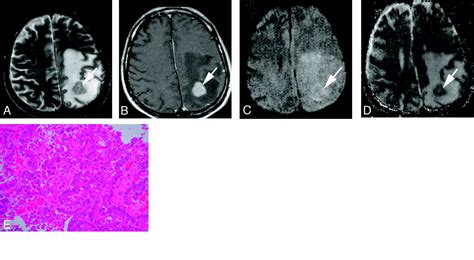 Diffusion Weighted Imaging Of Metastatic Brain Tumors Comparison With
