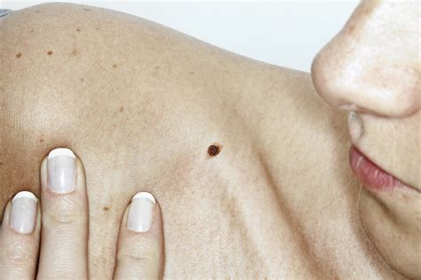 What You Need To Know About Skin Cancer And How To Protect Yourself