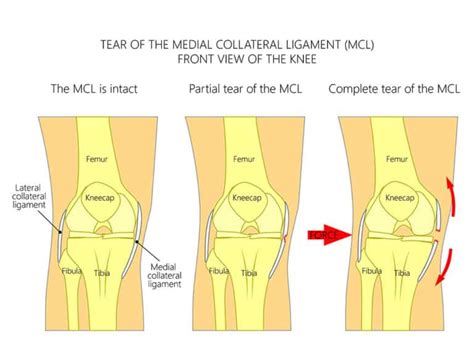 Mcl Sprain Recovery Time Injury Health Blog