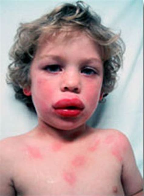 Food Allergy Causes Symptoms Treatment Food Allergy