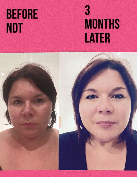 Health Treatment Hypothyroid In Photos Before And After