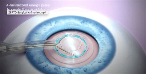 Zepto For Cataract Surgery In Houston Mark C Vital Md