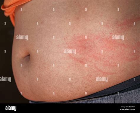 Réaction Allergique Sur La Peau Image Banque De Photographies Et D