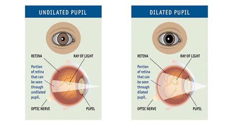 The Importance Of Pupil Dilation At An Eye Exam And Why We Do Them