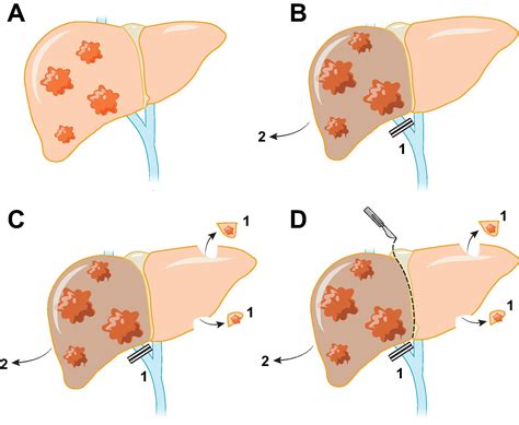Liver Resection For Cancer New Developments In Prediction Prevention