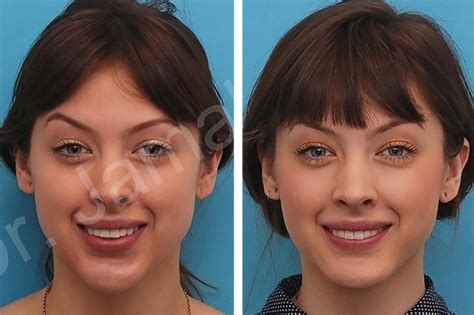 Cosmetic Transformations You Have To See To Believe The Healthy