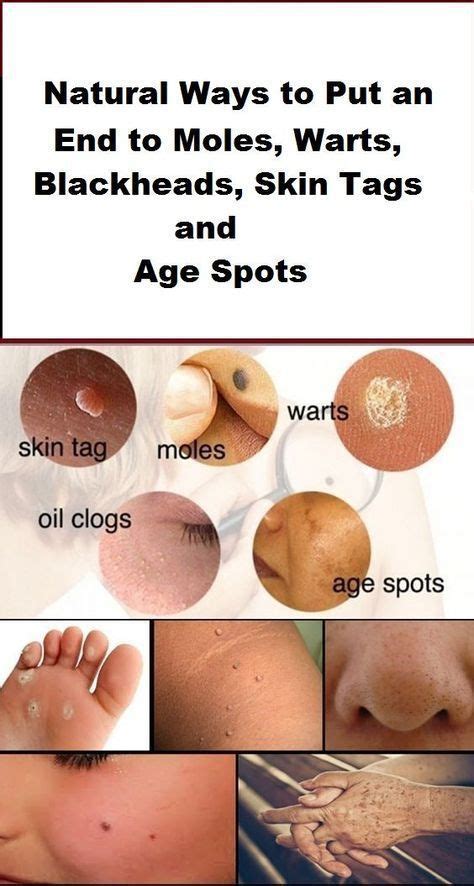 natural ways to put an end to moles warts blackheads skin tags and age spots we all can have