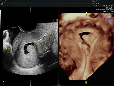 Gis And Sis Ultrasound To Determine The Causes Of Menorrhagia Empowered