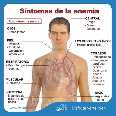 Apuntes Médicos A La Mano Síntomas De La Anemia