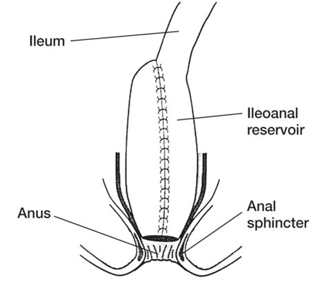 Ileoanal Pouch Anastomosis With Labels For The Ileum Ileal Reservoir Anus And Anal Sphincter