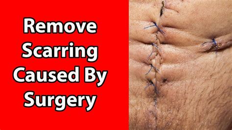 How To Naturally Remove Scars Caused By Surgery Youtube