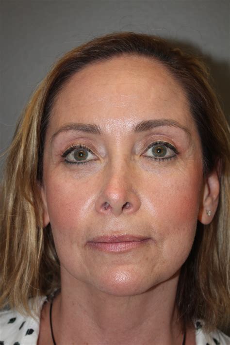 Patient 141113668 Eyelid Surgery Before And After Photos Texas Facial