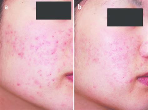 Patient Eight Mild Acne A At Baseline Gags18 B At 3 Months