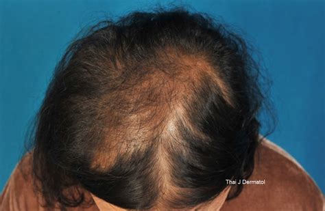 Diffuse Neurofibroma Of The Scalp With Alopecia A Case Report Thai