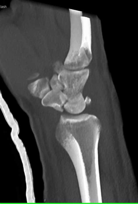 Fracturedislocation Of The Carpal Bones Musculoskeletal Case Studies