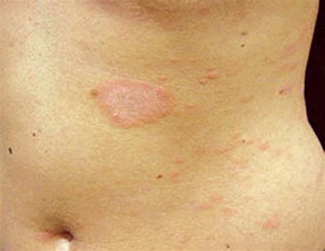 Pityriasis Rosea Pictures Stages Causes Treatment Causes