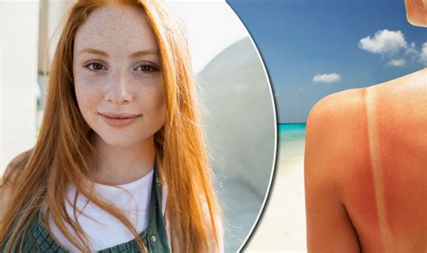 Scientists Confirm Red Heads Are More Likely To Get Skin Cancer Uk