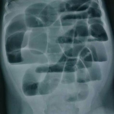 X Ray Abdomen In Erect Posture Showing Multiple Air Fluid Levels