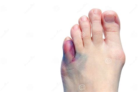 Bruises Bunions Broken Toes Stock Image Image Of Aging Abnormality