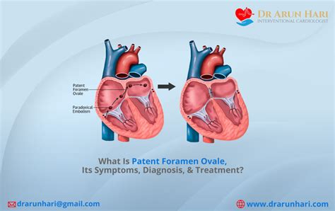 What Is Patent Foramen Ovale Its Symptoms Diagnosis And Treatment