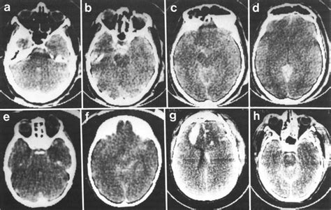Intraventricular Hemorrhage In Severe Head Injury In Journal Of