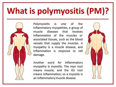 Medical School Polymyositiswhat To Know Polymyositis Muscle