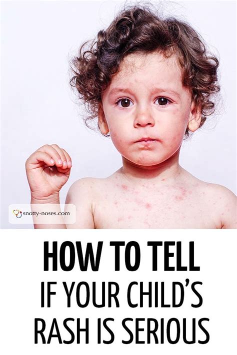 Rashes In Children Snotty Noses